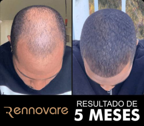 Antes e depois do transplante capilar 1