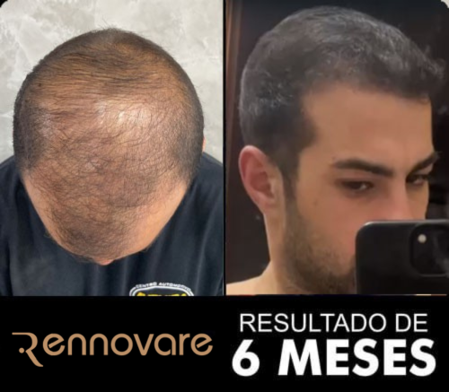 Antes e depois do transplante capilar 2