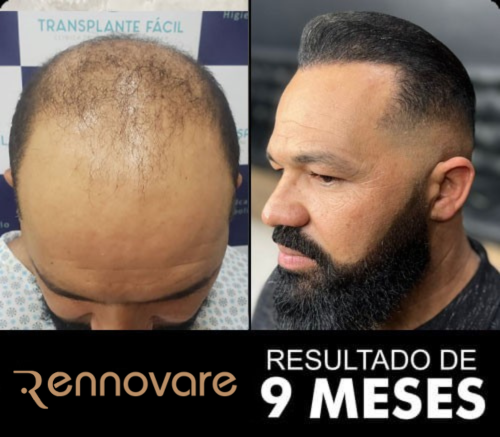 Antes e depois do transplante capilar 3