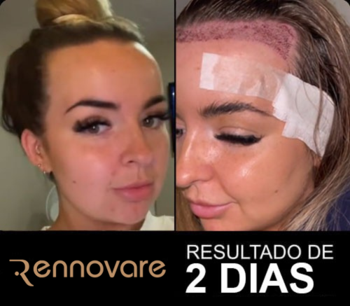 Resultados do transplante capilar feminino 1
