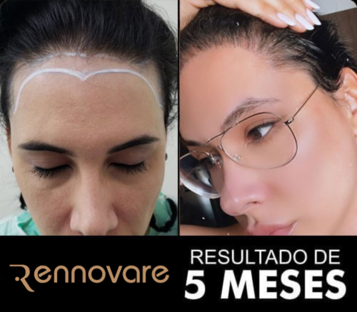 Resultados do transplante capilar feminino 2