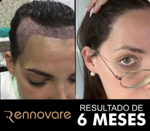 Resultados do transplante capilar feminino 3