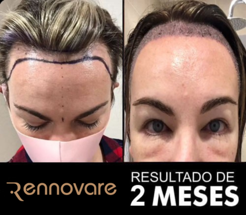 Resultados do transplante capilar feminino 4